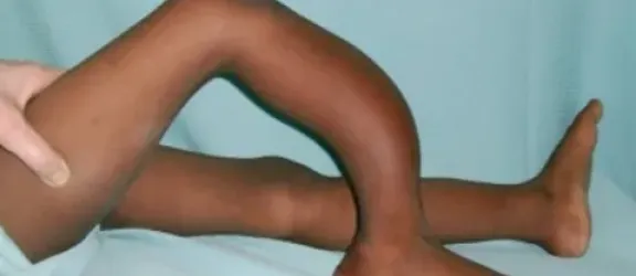 Mädchen mit stark verkrümmten Bein durch Fluorose